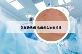 怎样治头癣 头癣怎么治能根除