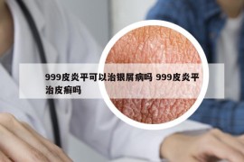 999皮炎平可以治银屑病吗 999皮炎平治皮癣吗