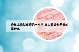 身体上类似皮癣的一小块 身上起类似于癣的是什么