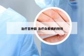 治疗百种藓 治疗白癣病的特效