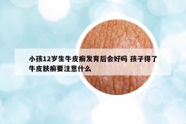 小孩12岁生牛皮癣发育后会好吗 孩子得了牛皮肤癣要注意什么