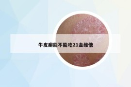 牛皮癣能不能吃21金维他