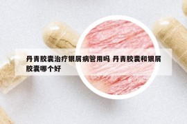 丹青胶囊治疗银屑病管用吗 丹青胶囊和银屑胶囊哪个好