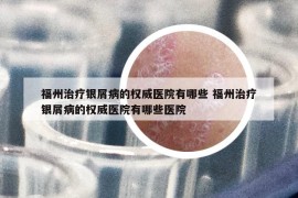 福州治疗银屑病的权威医院有哪些 福州治疗银屑病的权威医院有哪些医院