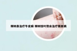 柳树条治疗牛皮癣 柳树枝叶熬水治疗银屑病