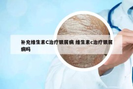 补充维生素C治疗银屑病 维生素c治疗银屑病吗