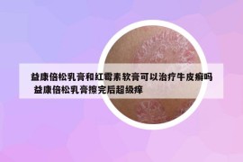 益康倍松乳膏和红霉素软膏可以治疗牛皮癣吗 益康倍松乳膏擦完后超级痒