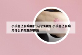 小孩腿上有癣用什么药效果好 小孩腿上有癣用什么药效果好得快