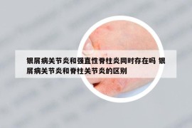 银屑病关节炎和强直性脊柱炎同时存在吗 银屑病关节炎和脊柱关节炎的区别