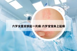 六岁女童皮肤起一片癣 六岁宝宝身上起癣