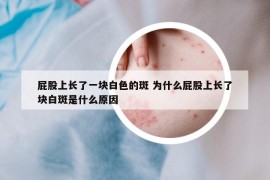 屁股上长了一块白色的斑 为什么屁股上长了块白斑是什么原因