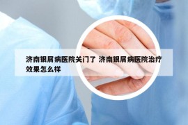 济南银屑病医院关门了 济南银屑病医院治疗效果怎么样