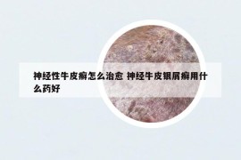 神经性牛皮癣怎么治愈 神经牛皮银屑癣用什么药好