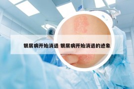 银屑病开始消退 银屑病开始消退的迹象