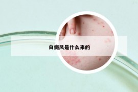 白癜风是什么来的