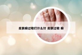 皮肤癣过敏打什么针 皮肤过敏 癣