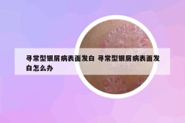 寻常型银屑病表面发白 寻常型银屑病表面发白怎么办