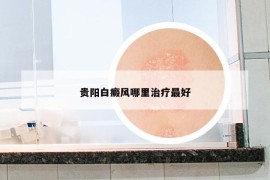 贵阳白癜风哪里治疗最好