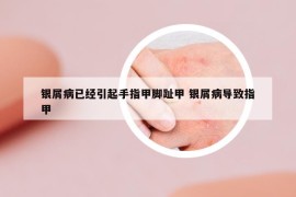 银屑病已经引起手指甲脚趾甲 银屑病导致指甲