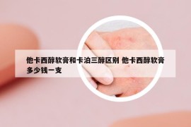 他卡西醇软膏和卡泊三醇区别 他卡西醇软膏多少钱一支