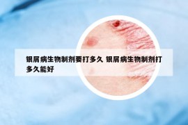 银屑病生物制剂要打多久 银屑病生物制剂打多久能好