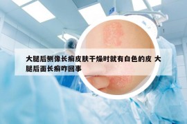 大腿后侧像长癣皮肤干燥时就有白色的皮 大腿后面长癣咋回事