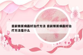 目前银屑病最好治疗方法 目前银屑病最好治疗方法是什么