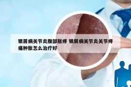 银屑病关节炎腹部胀疼 银屑病关节炎关节疼痛肿胀怎么治疗好