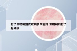 打了生物制剂皮肤病多久能好 生物制剂打了起红疹