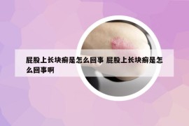 屁股上长块癣是怎么回事 屁股上长块癣是怎么回事啊