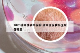 2023渝中楼到牛皮癣 渝中区皮肤科医院在哪里