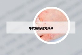 牛皮癣新研究成果