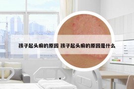 孩子起头癣的原因 孩子起头癣的原因是什么