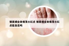 银屑病全身爆发小红点 银屑病全身爆发小红点能自愈吗