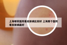上海哪家医院看皮肤病比较好 上海那个医院看皮肤病最好