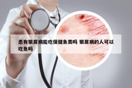 患有银屑病能吃保健鱼类吗 银屑病的人可以吃鱼吗