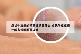 点状牛皮癣的初期症状是什么 点状牛皮皮癣一般多长时间可以好