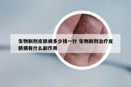 生物制剂皮肤病多少钱一针 生物制剂治疗皮肤病有什么副作用