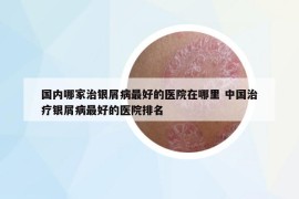 国内哪家治银屑病最好的医院在哪里 中国治疗银屑病最好的医院排名