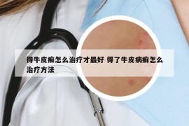 得牛皮癣怎么治疗才最好 得了牛皮病癣怎么治疗方法