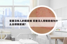 家里没有人的银屑病 家里没人得银屑病为什么会得银屑病?