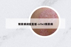 银屑病讲座直播 cctv2银屑病