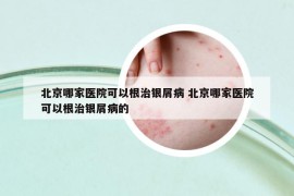 北京哪家医院可以根治银屑病 北京哪家医院可以根治银屑病的