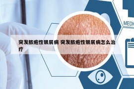 突发脓疱性银屑病 突发脓疱性银屑病怎么治疗