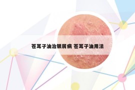 苍耳子油治银屑病 苍耳子油用法