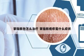 掌指脓包怎么治疗 掌指脓疱疹是什么症状