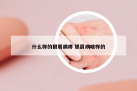 什么样的银屑病疼 银屑病啥样的