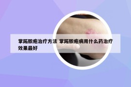 掌跖脓疱治疗方法 掌跖脓疱病用什么药治疗效果最好