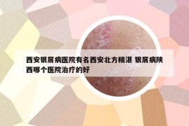 西安银屑病医院有名西安北方精湛 银屑病陕西哪个医院治疗的好