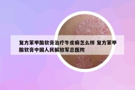 复方苯甲酸软膏治疗牛皮癣怎么样 复方苯甲酸软膏中国人民解放军总医院